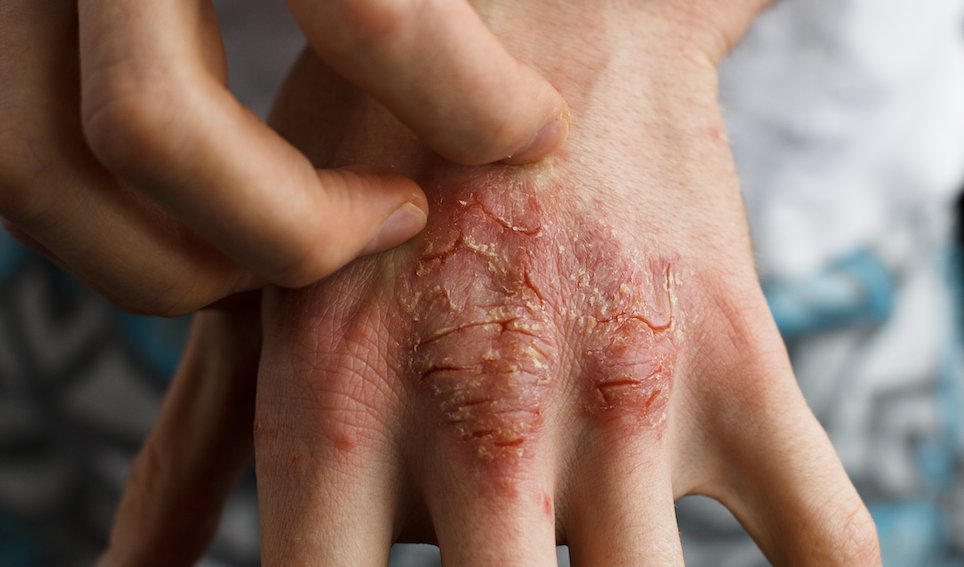 What is Eczema?